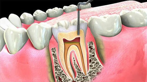 Root canal treatment at Om Sai Ram Dental Clinic